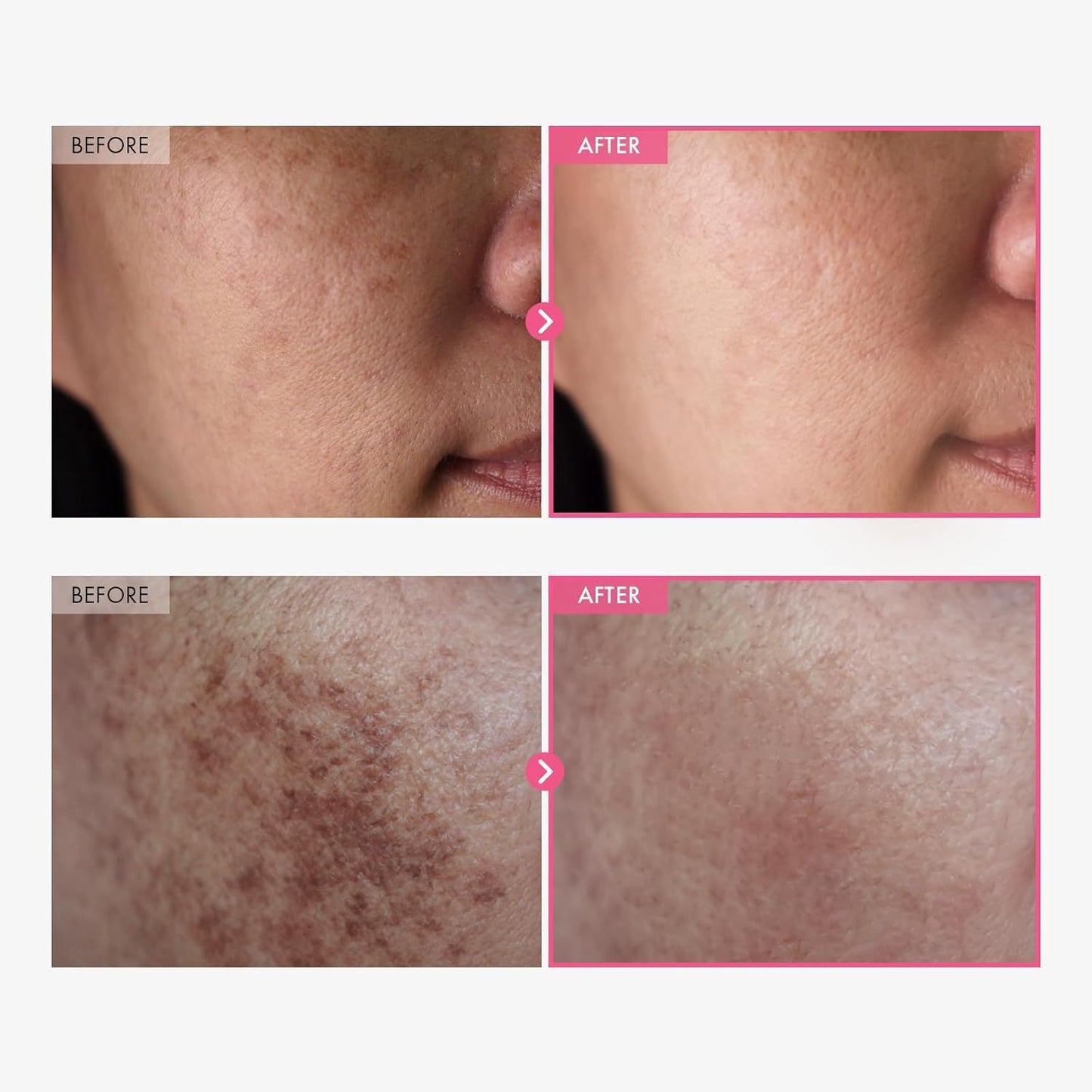 Arbutin Tranexamic Acid Cream